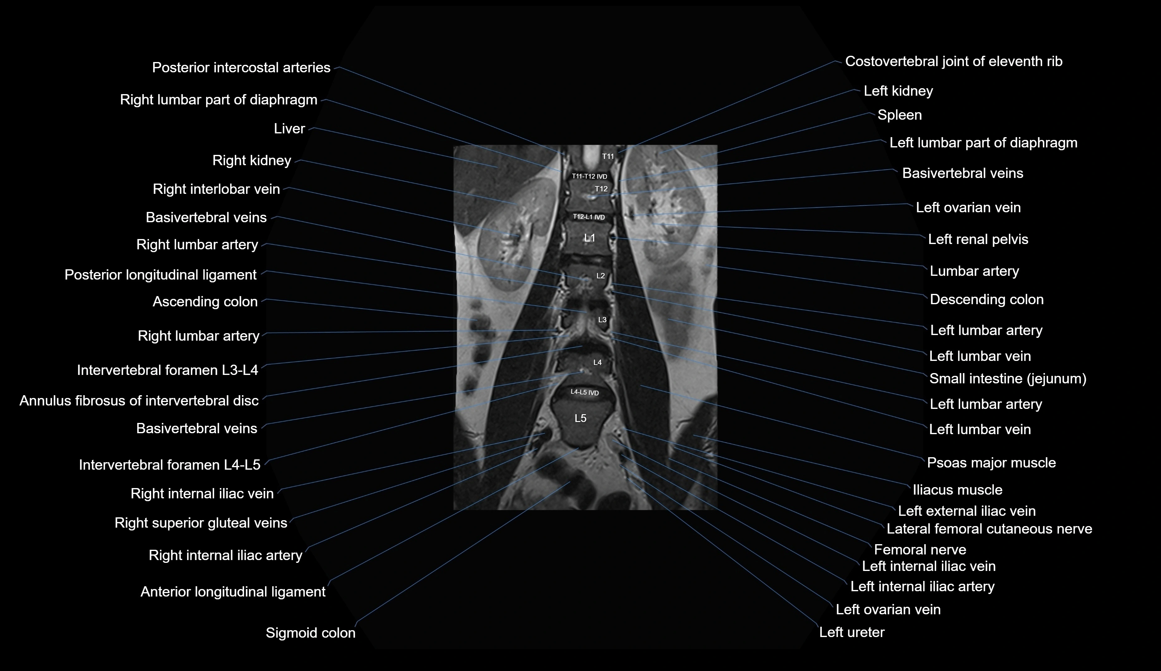 MRI lumbar spine coronal cross sectional anatomy 3T radiology  image-img-00001-00015.webp